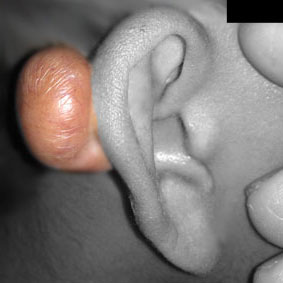 ear-keloid-1