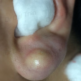 ear-lobe-cyst-1