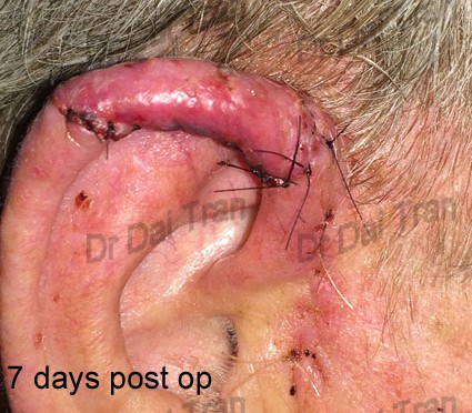 ear-skin-cancer-4-425x372