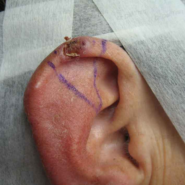 ear-wedge-excision-surgery-2