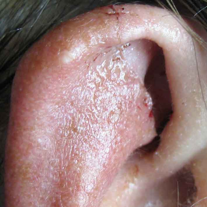 ear-wedge-excision-surgery-4