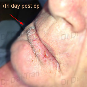 lip-vermilionectomy-m-3-updraft-pre-smush-original