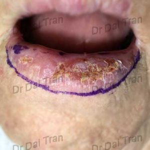 lip-vermillionectomy-1