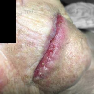 lip-vermillionectomy-4