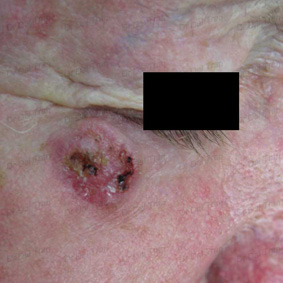 lower-eyelid-skin-graft-basal-cell-carcinoma-1