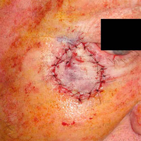 lower-eyelid-skin-graft-basal-cell-carcinoma-2