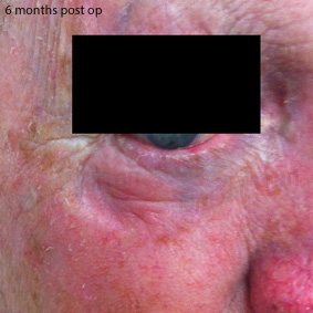 lower-eyelid-skin-graft-basal-cell-carcinoma-3