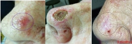 serial curettage and cautery of skin cancer