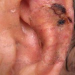 skin-graft-ear-1-150x150