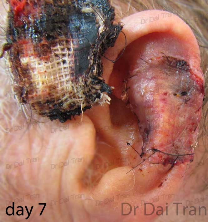 skin-graft-ear-3