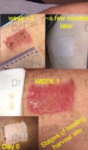 skin-graft-stages-of-healing