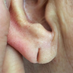 split ear lobe