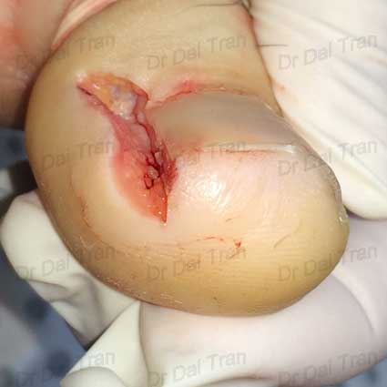 wedge-excision-ingrown-toe-nail